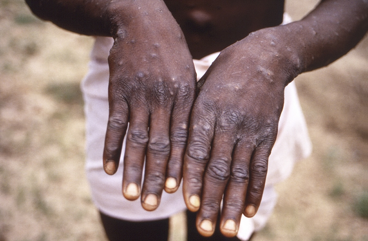 Ιός mpox: Πώς μεταδίδεται η ευλογιά των πιθήκων – Οι οδηγίες του ΕΟΔΥ και ο εμβολιασμός